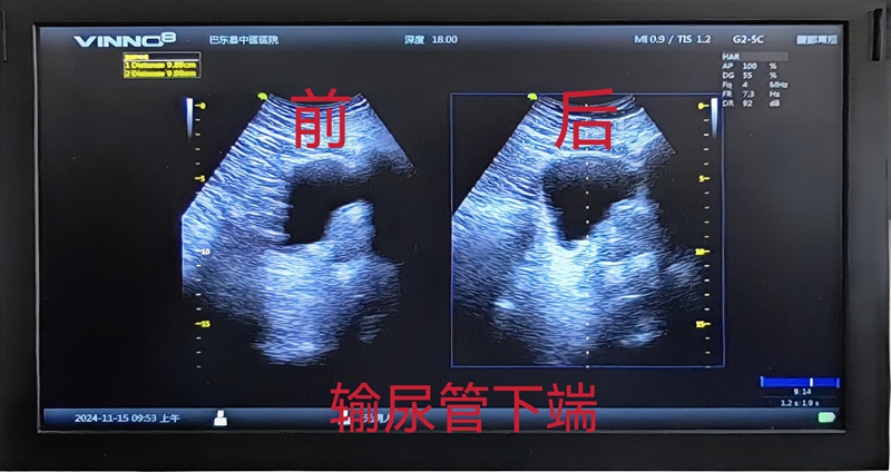 输尿管下断碎石对比图_副本