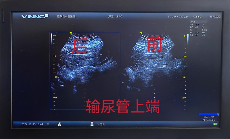 输尿管上端碎石对比图_副本
